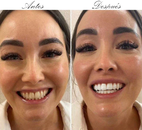 HISMILE BLANQUEADOR DENTAL V34 ORIGINAL - GRATIS CEPILLO